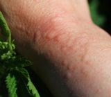 Quick Remedies for Nettle Stings – Home & Family > Plants